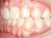 After - Ali Orthodontics Dental