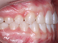 After - Ali Orthodontics Dental