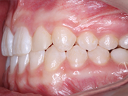 After - Ali Orthodontics Dental
