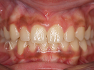 After - Ali Orthodontics Dental