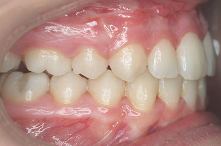 After - Ali Orthodontics Dental