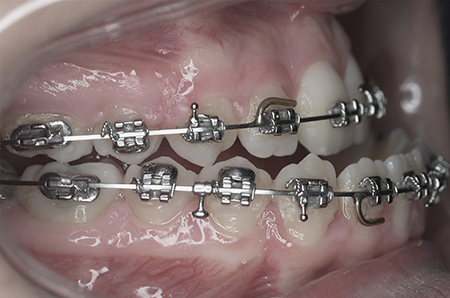 During - Ali Orthodontics Dental