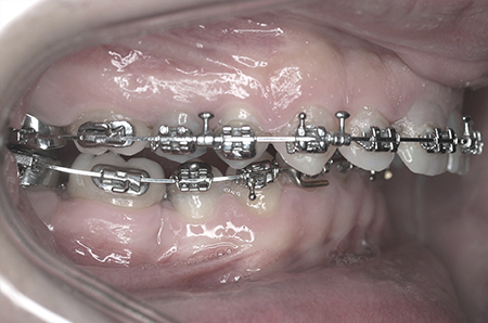 During - Ali Orthodontics Dental