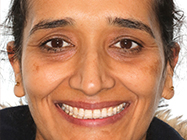 After - Ali Orthodontics Dental