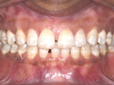 Before - Ali Orthodontics Dental