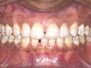 Before - Ali Orthodontics Dental