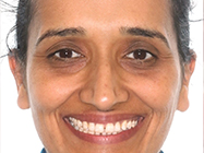 Before - Ali Orthodontics Dental